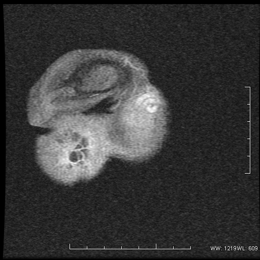 File:Non-seminomatous germ cell tumor (Radiopaedia 16649-16352 Coronal T1 C+ 1).png