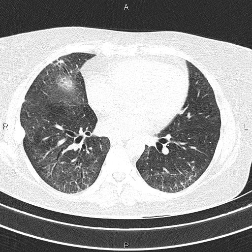 Non-specific interstitial pneumonia (Radiopaedia 83185-97567 Axial lung window 39).jpg
