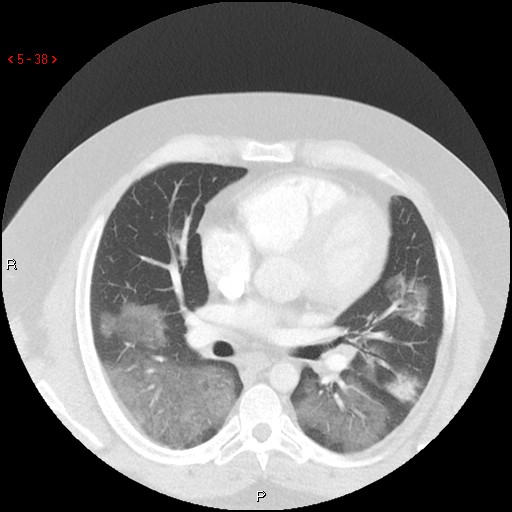 File:Non-specific interstitial pneumonitis (Radiopaedia 27044-27222 Axial lung window 29).jpg