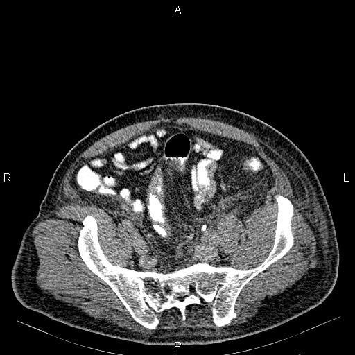 Non Hodgkin lymphoma in a patient with ankylosing spondylitis (Radiopaedia 84323-99621 Axial C+ delayed 61).jpg