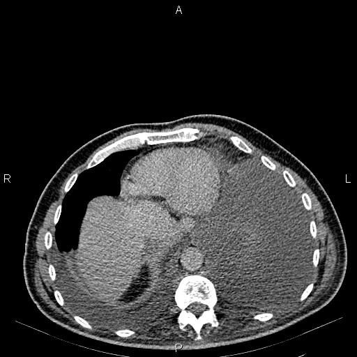Non Hodgkin lymphoma in a patient with ankylosing spondylitis (Radiopaedia 84323-99621 Axial C+ delayed 7).jpg