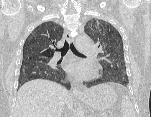 Non specific interstitial pneumonia (NSIP) (Radiopaedia 89725-106798 Coronal lung window 43).jpg