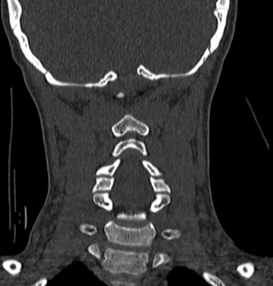 File:Normal CT cervical spine - 12-year-old (Radiopaedia 55352-61775 Coronal bone window 141).jpg