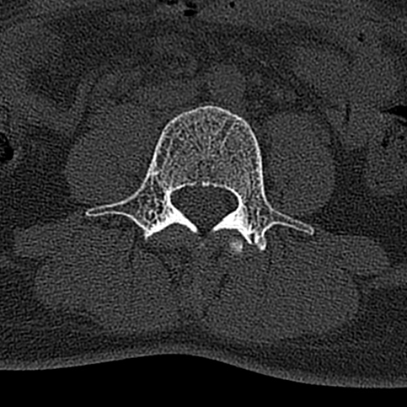 File:Normal CT lumbar spine (Radiopaedia 53981-60118 Axial bone window 45).jpg