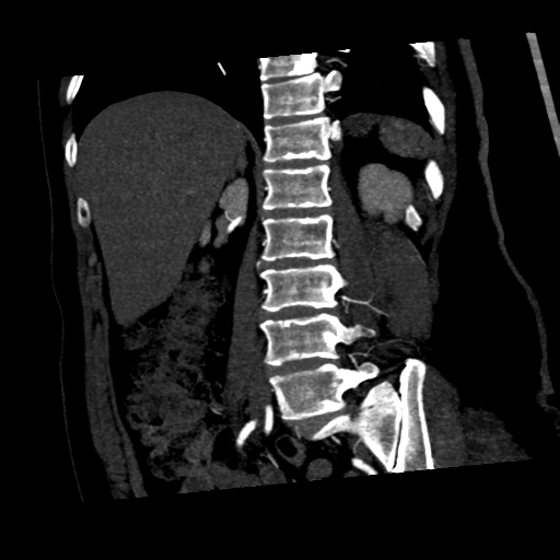 File:Normal CT renal artery angiogram (Radiopaedia 38727-40889 C 17).png