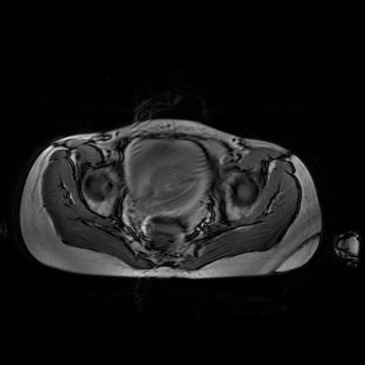 File:Normal MRI abdomen in pregnancy (Radiopaedia 88001-104541 Axial Gradient Echo 50).jpg