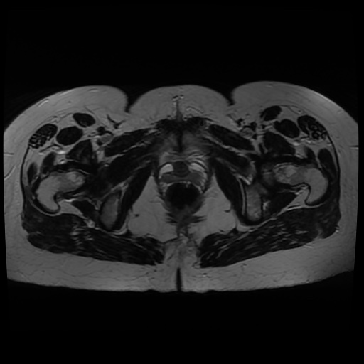 Normal MRI abdomen in pregnancy (Radiopaedia 88005-104548 Axial T2 45).jpg