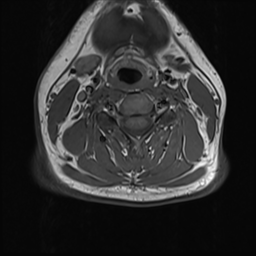 File:Normal MRI cervical spine (infection protocol) (Radiopaedia 53916-60039 Axial 26).png