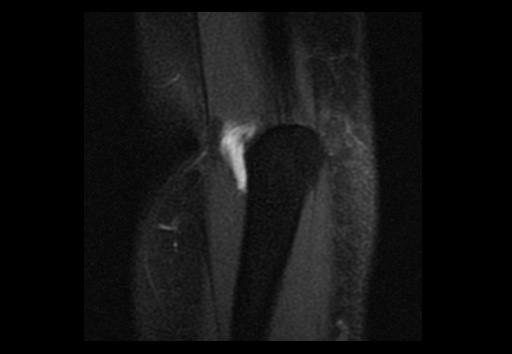 File:Normal elbow arthrograms (Radiopaedia 75550-86805 Coronal T1 fat sat 2).jpg