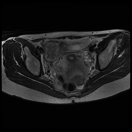 File:Normal female pelvis MRI (retroverted uterus) (Radiopaedia 61832-69933 Axial T2 17).jpg