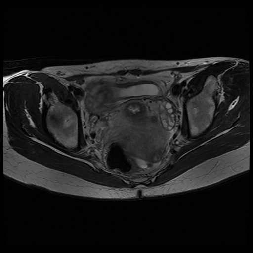 File:Normal female pelvis MRI (retroverted uterus) (Radiopaedia 61832-69933 Axial T2 18).jpg