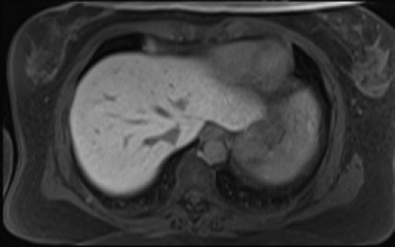 File:Normal hepatobiliary phase liver MRI (Radiopaedia 58968-66230 A 19).jpg