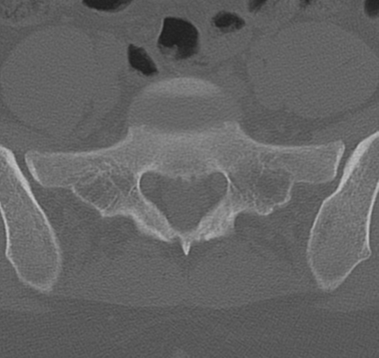 File:Normal lumbar spine CT (Radiopaedia 46533-50986 Axial bone window 67).png