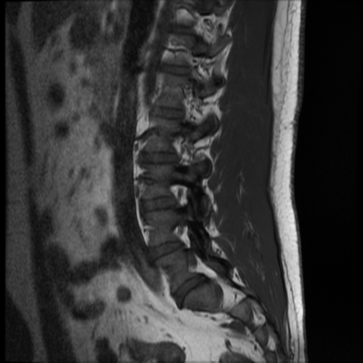 File:Normal lumbar spine MRI (Radiopaedia 35543-37039 Sagittal T1 10).png
