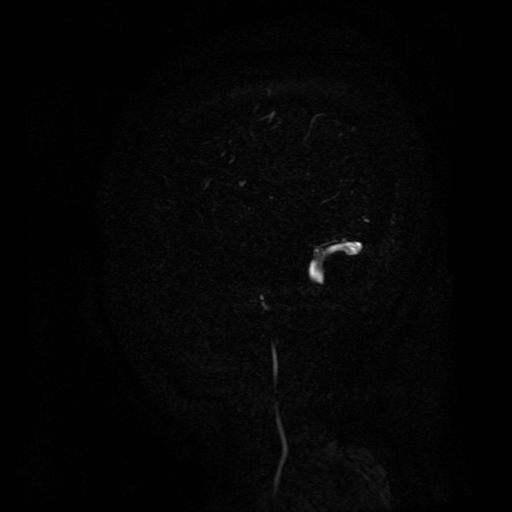 Normal noncontrast MR venography (Radiopaedia 87578-103957 A 151).jpg