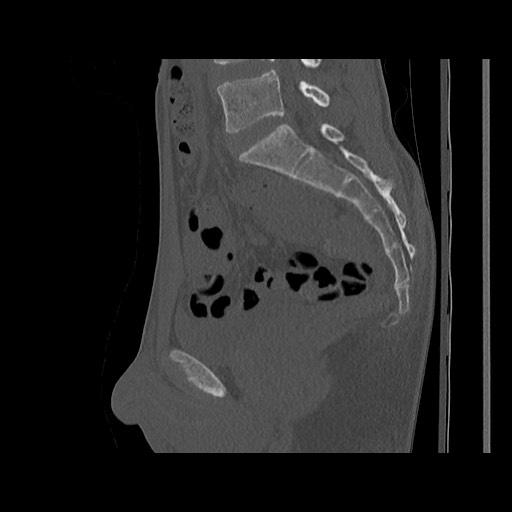 Normal pelvis (Radiopaedia 51473-57238 Sagittal bone window 73).jpg