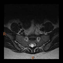 File:Normal spine MRI (Radiopaedia 77323-89408 Axial T2 29).jpg