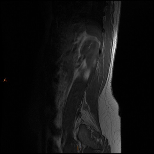 File:Normal spine MRI (Radiopaedia 77323-89408 Sagittal T1 14).jpg