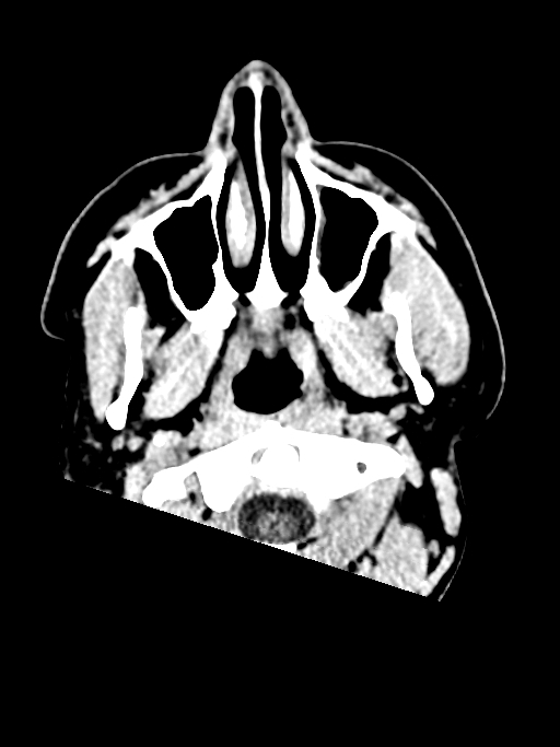 Normal trauma protocol brain and C-spine CT (Radiopaedia 83302-97709 Axial non-contrast 73).jpg