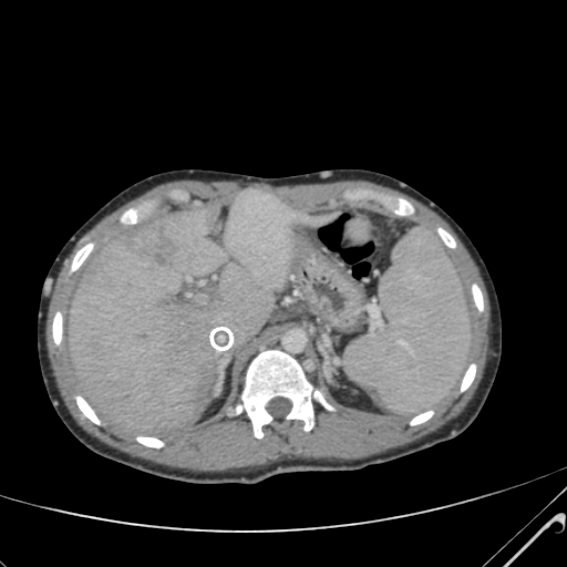 File:Nutmeg liver- Budd-Chiari syndrome (Radiopaedia 46234-50635 B 17).png