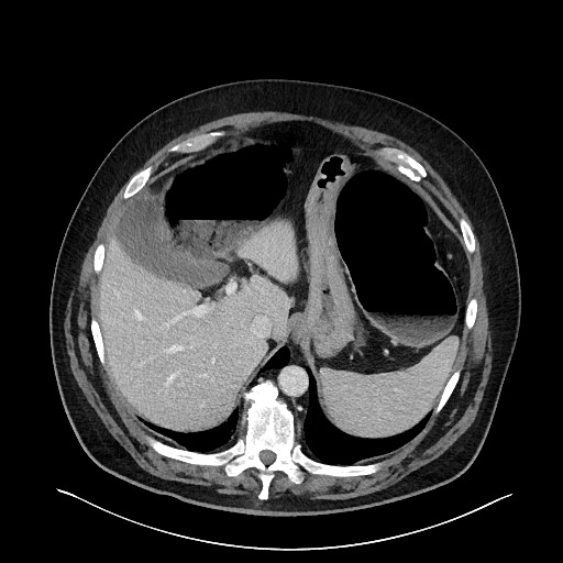 File:Obstructing sigmoid adenocarcinoma (Radiopaedia 58465-65619 A 35).jpg