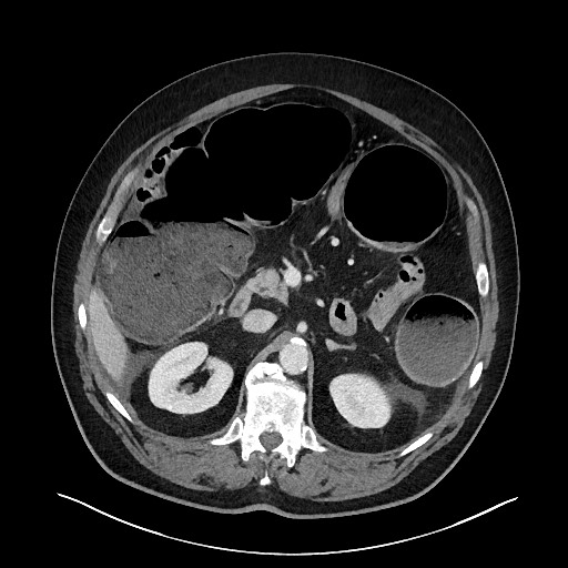 Obstructing sigmoid adenocarcinoma (Radiopaedia 58465-65619 A 56).jpg