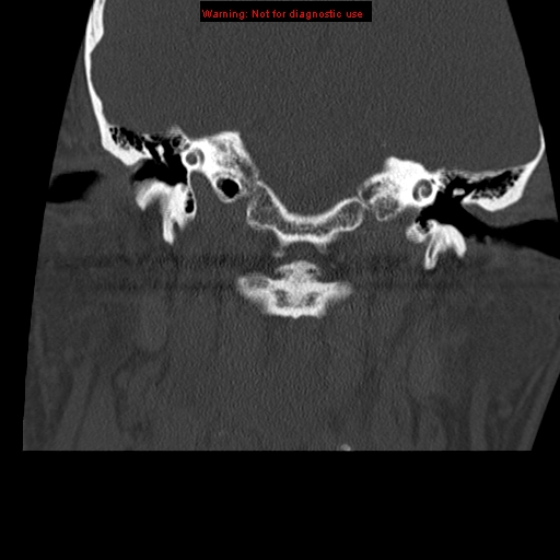 File:Occipital condyle fracture (Radiopaedia 18366-18208 Coronal bone window 4).jpg