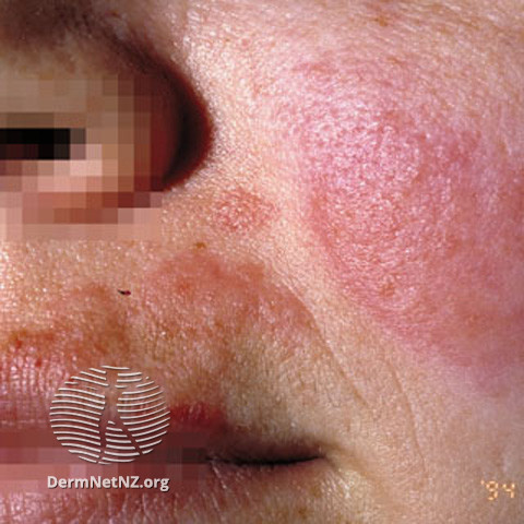 File:(DermNet NZ dermatitis-acd-face-2438).jpg