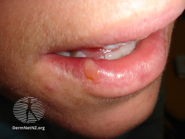File:(DermNet NZ herpes-simplex-labialis-12).jpg