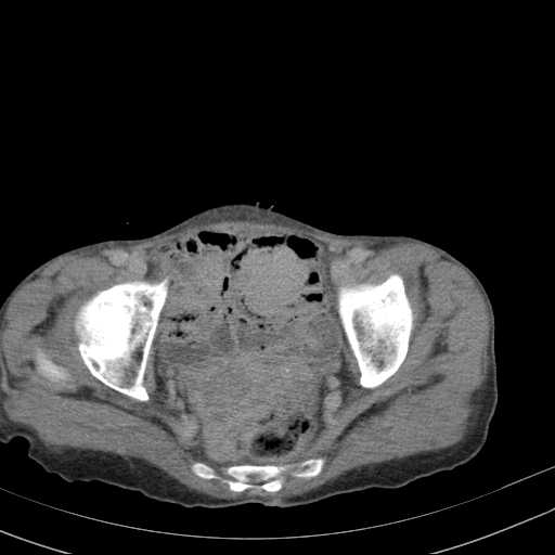 File:Abdominal aortic aneurysm (Radiopaedia 20827-20742 Axial C+ delayed 33).jpg