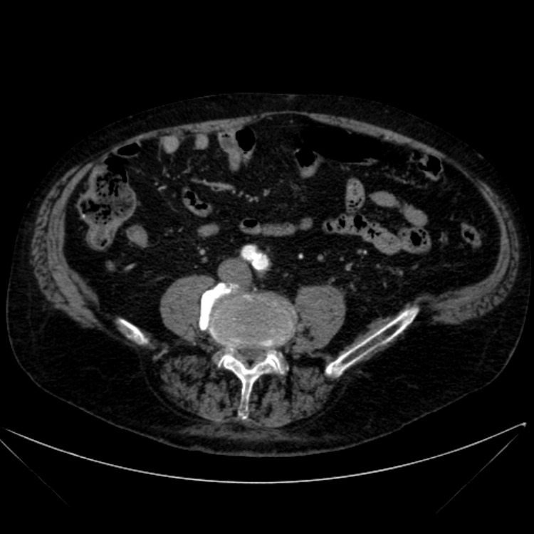 Abdominal aortic aneurysm (Radiopaedia 25855-26001 Axial C+ arterial phase 86).jpg