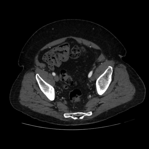 File:Abdominal aortic aneurysm (Radiopaedia 57318-64259 Axial C+ arterial phase 64).jpg