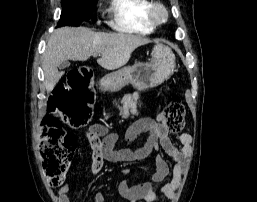 File:Abdominal aortic aneurysm (Radiopaedia 67117-76452 Coronal C+ arterial phase 9).jpg
