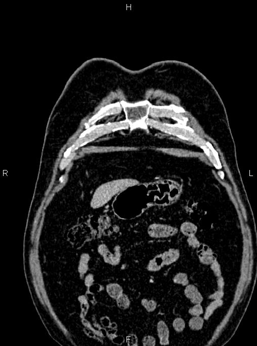 Abdominal aortic aneurysm (Radiopaedia 83094-97462 Coronal renal cortical phase 18).jpg
