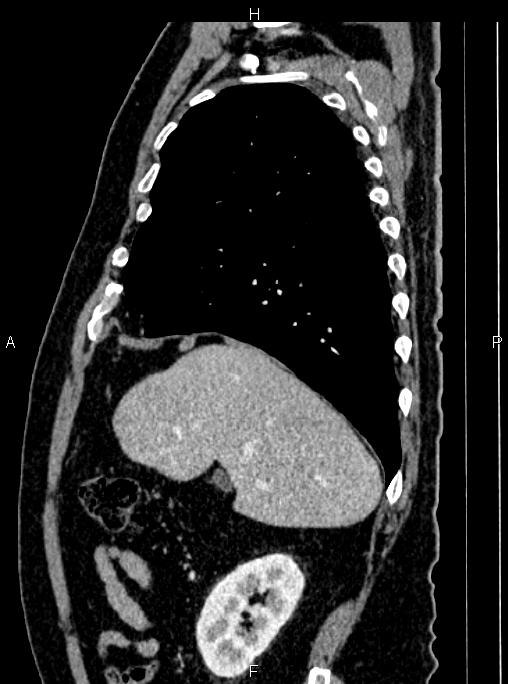 Abdominal aortic aneurysm (Radiopaedia 83094-97462 Sagittal renal cortical phase 36).jpg