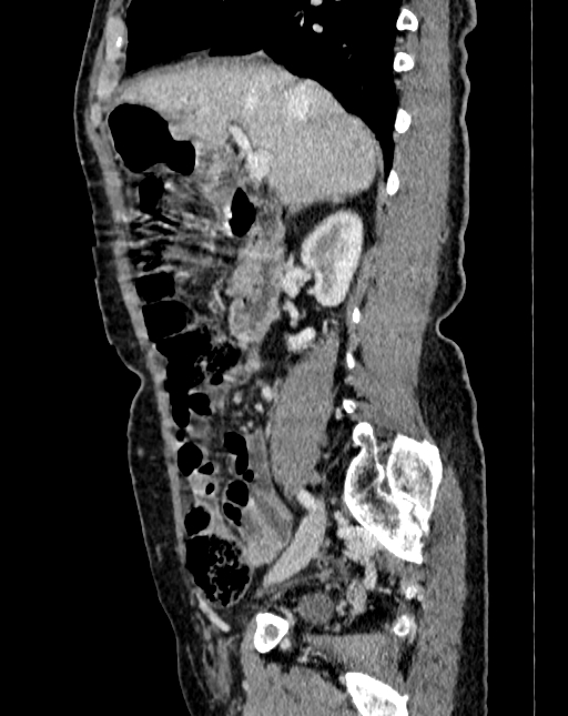 Abdominal aortic aneurysm (Radiopaedia 83581-98689 Sagittal C+ portal venous phase 16).jpg
