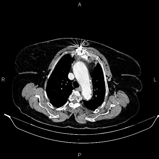 File:Abdominal aortic aneurysm (Radiopaedia 85063-100606 Axial C+ portal venous phase 12).jpg