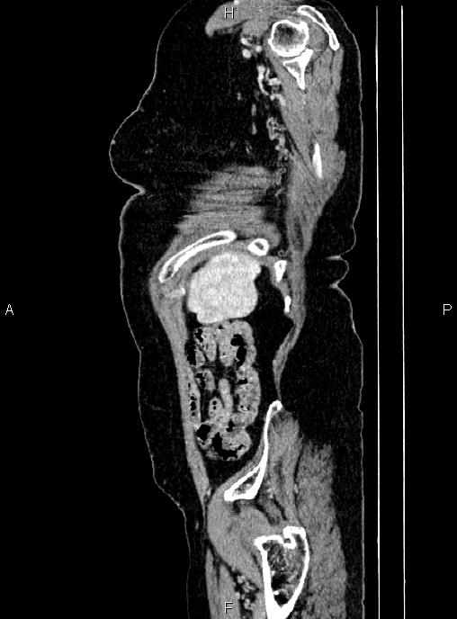 Abdominal aortic aneurysm (Radiopaedia 85063-100606 Sagittal C+ arterial phase 75).jpg