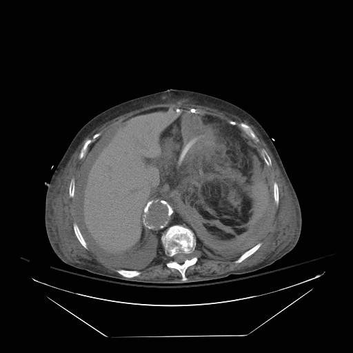 Abdominal aortic aneurysm - impending rupture (Radiopaedia 19233-19247 Axial non-contrast 46).jpg