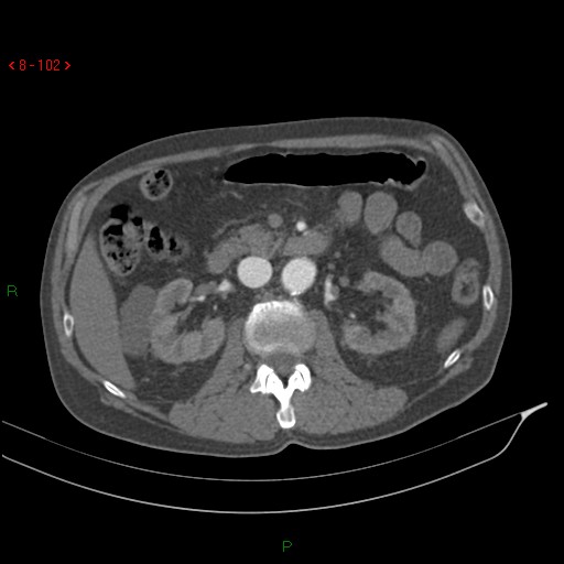 Abdominal aortic aneurysm rupture with aortocaval fistula (Radiopaedia 14897-14841 Axial C+ arterial phase 102).jpg