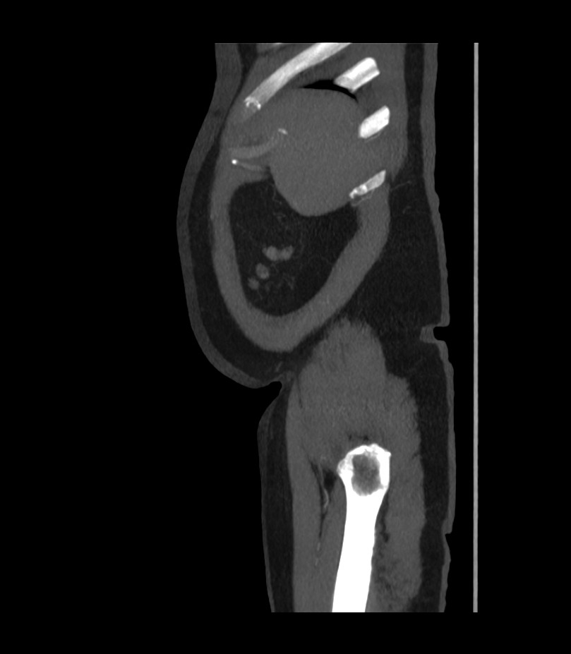 Abdominal aortic aneurysm with thrombus fissuration (Radiopaedia 46218-50618 Sagittal C+ arterial phase 4).jpg