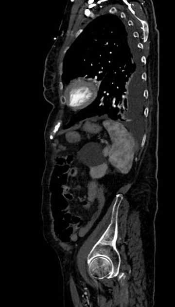 Abdominal aortic aneurysm with thrombus fissuration (Radiopaedia 73192-83919 Sagittal C+ arterial phase 25).jpg