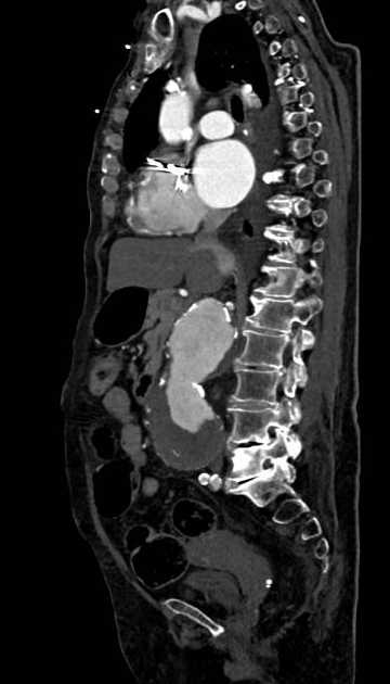 Abdominal aortic aneurysm with thrombus fissuration (Radiopaedia 73192-83919 Sagittal C+ arterial phase 76).jpg