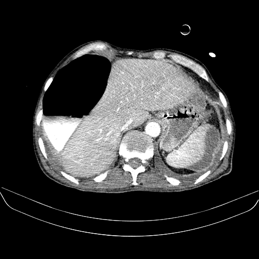 File:Abdominal collection due to previous cecal perforation (Radiopaedia 80831-94320 Axial C+ portal venous phase 34).jpg