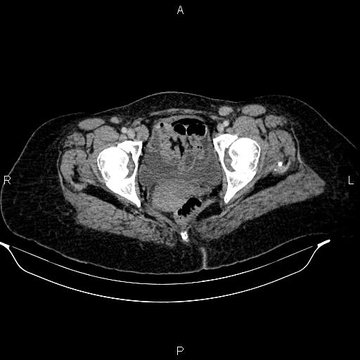 Abdominal lymphoma with sandwich sign (Radiopaedia 84378-99704 Axial C+ portal venous phase 55).jpg