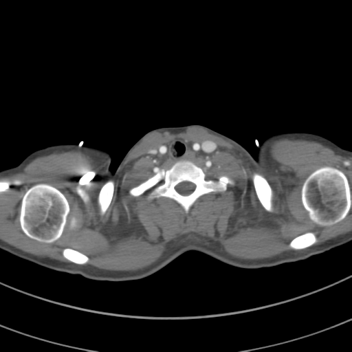 File:Abdominal multi-trauma - devascularised kidney and liver, spleen and pancreatic lacerations (Radiopaedia 34984-36486 Axial C+ arterial phase 6).png