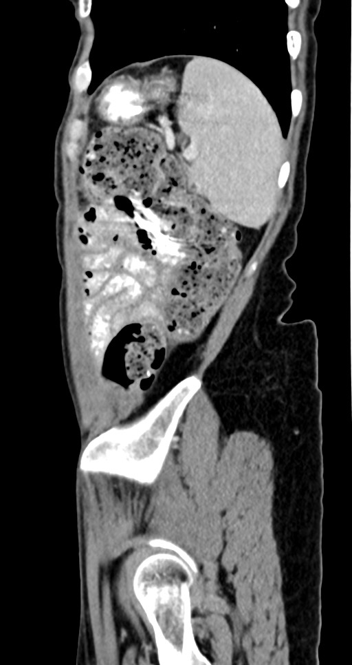 Abdominal wall and retroperitoneal tuberculosis (Radiopaedia 88137-104729 Sagittal C+ portal venous phase 30).jpg