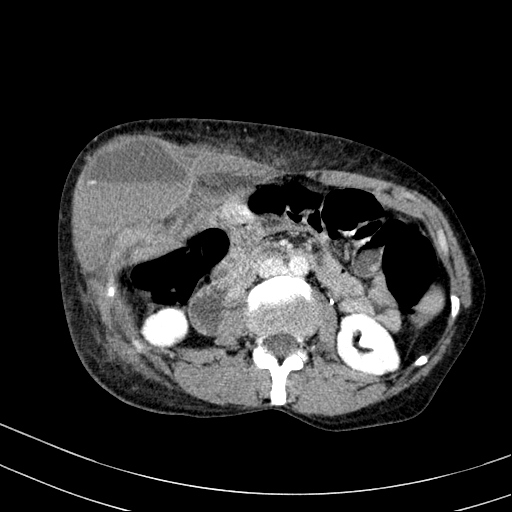 Abdominal wall hematoma with active bleeding (Radiopaedia 83915-99117 Axial C+ portal venous phase 35).jpg