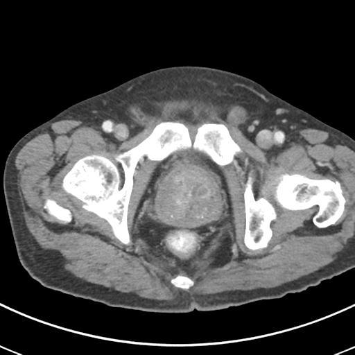 Abdominal wall metastasis from colorectal carcinoma (Radiopaedia 31016-31717 Axial C+ portal venous phase 75).jpg