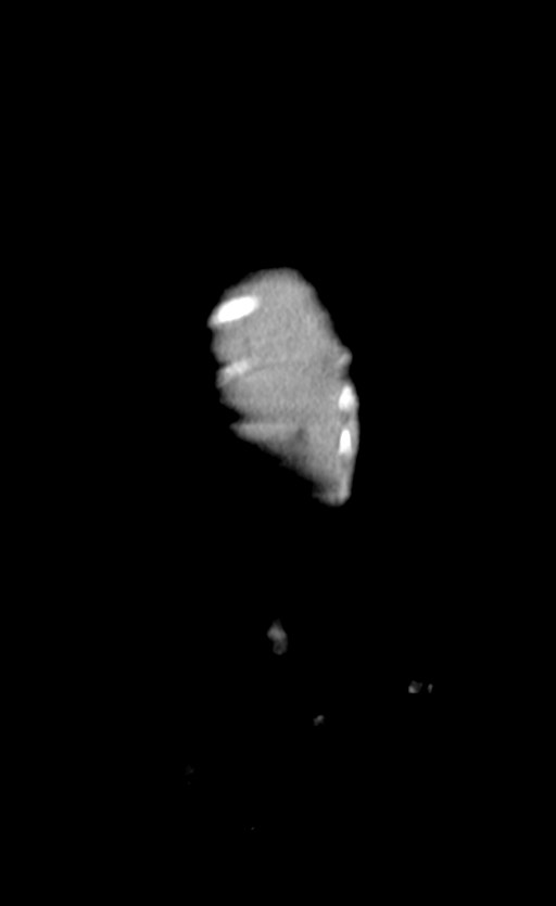 Abdominopelvic rhabdomyosarcoma (Radiopaedia 78356-90984 Coronal C+ portal venous phase 86).jpg
